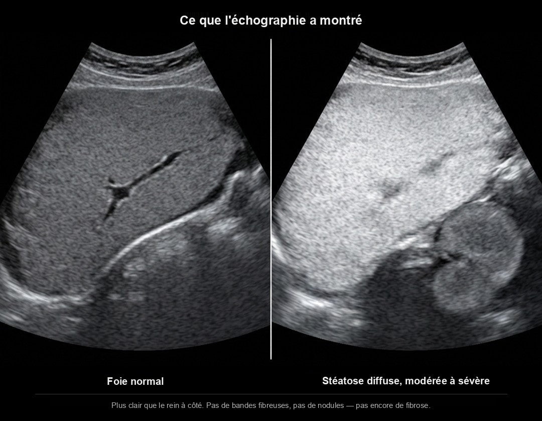 Two liver ultrasound images side by side: a normal liver, and one with moderate to severe diffuse steatosis