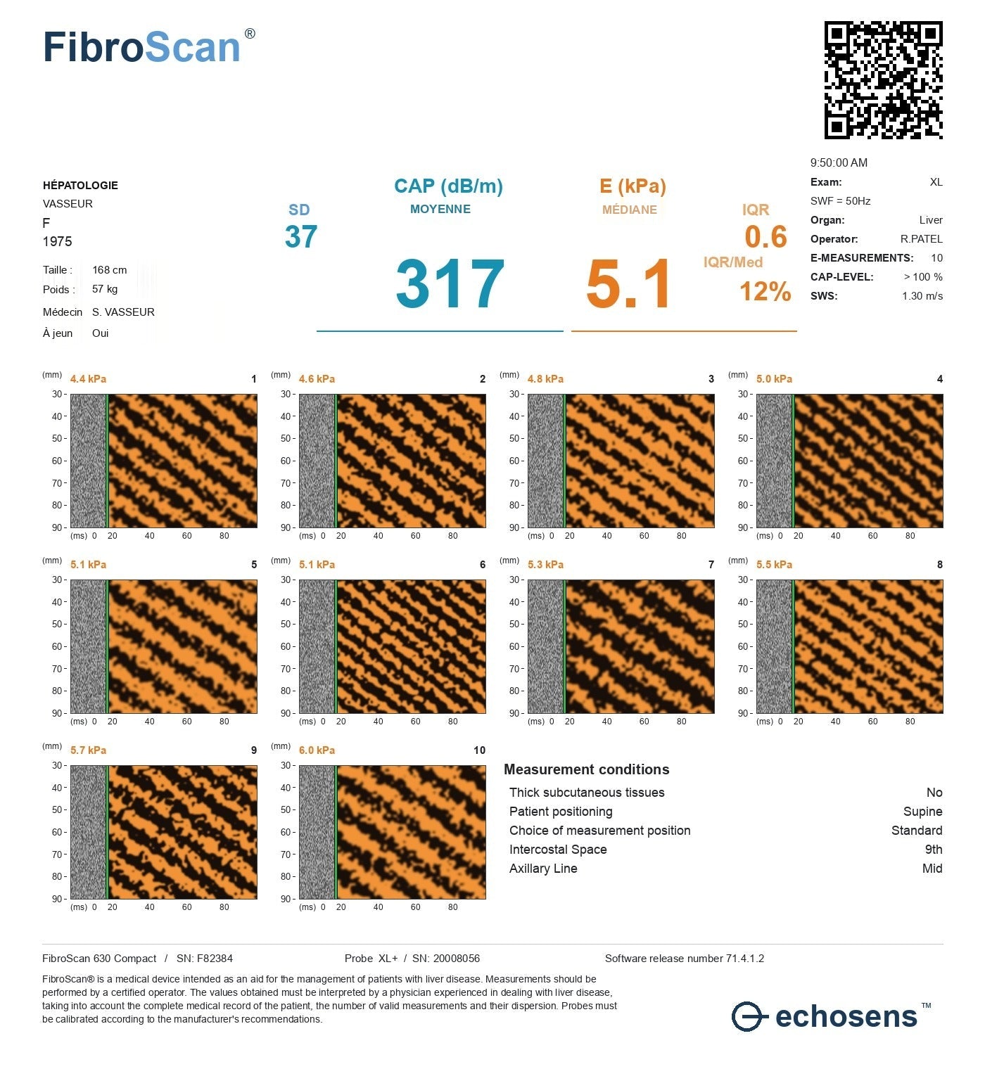 A liver elastography report: CAP 317 in the severe range for fat, and E 5.1 well inside the normal range for stiffness